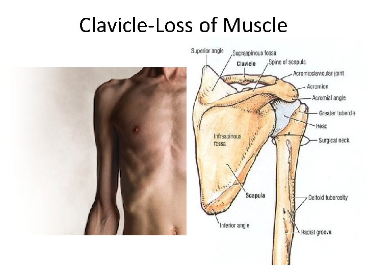 Clavicle-Loss of Muscle 