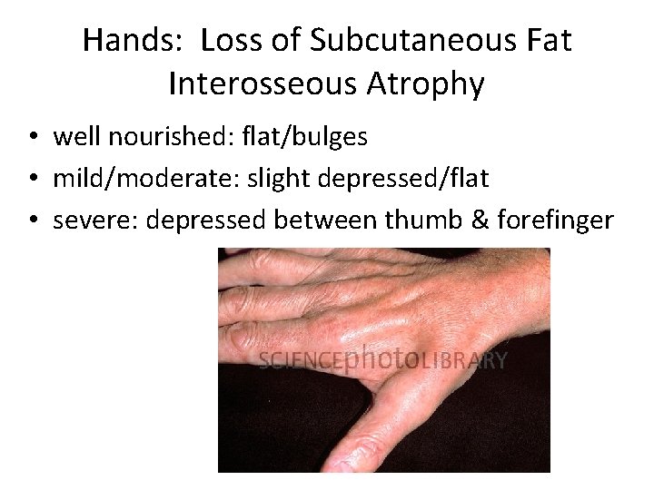 Hands: Loss of Subcutaneous Fat Interosseous Atrophy • well nourished: flat/bulges • mild/moderate: slight