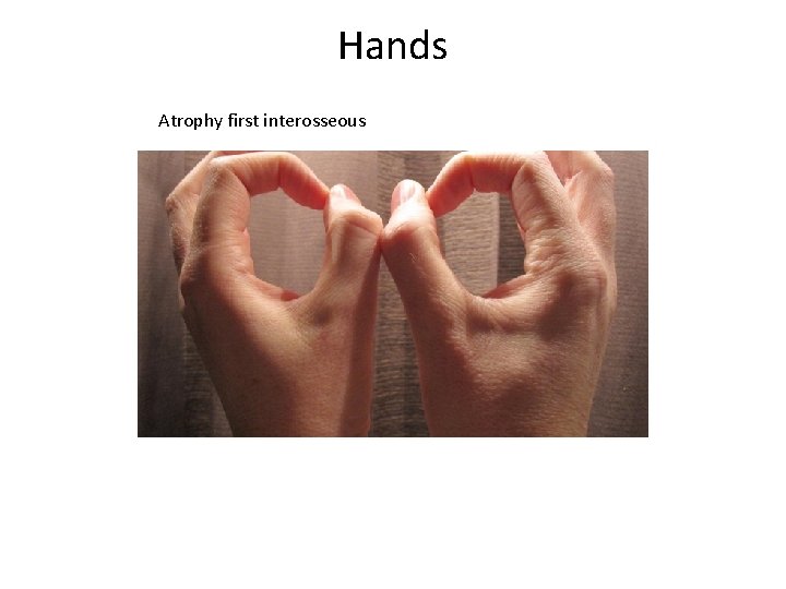 Hands Atrophy first interosseous 