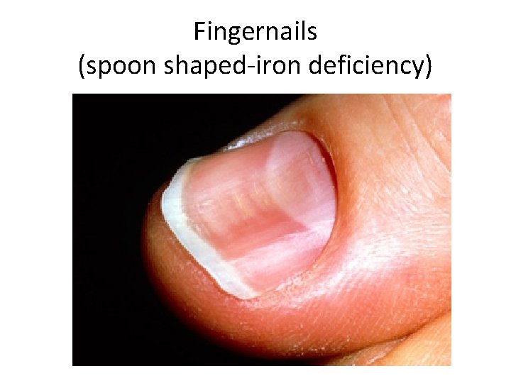 Fingernails (spoon shaped-iron deficiency) 