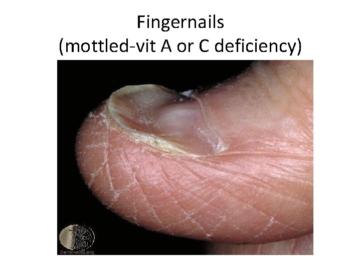 Fingernails (mottled-vit A or C deficiency) 