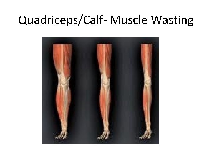 Quadriceps/Calf- Muscle Wasting 