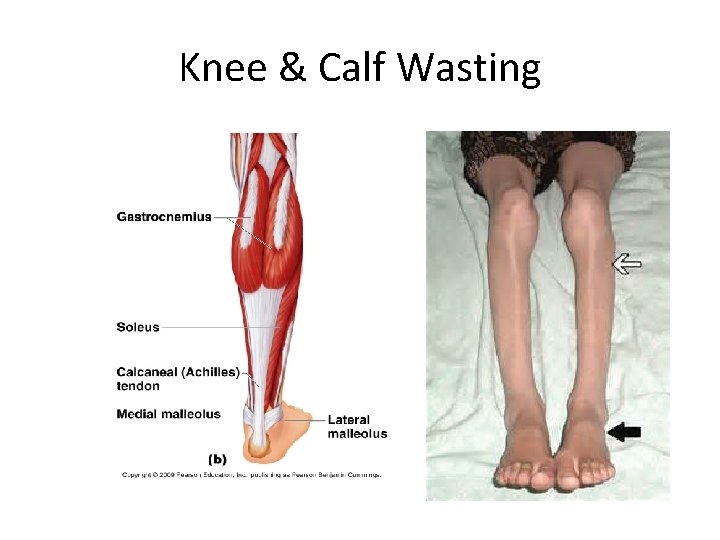 Knee & Calf Wasting 