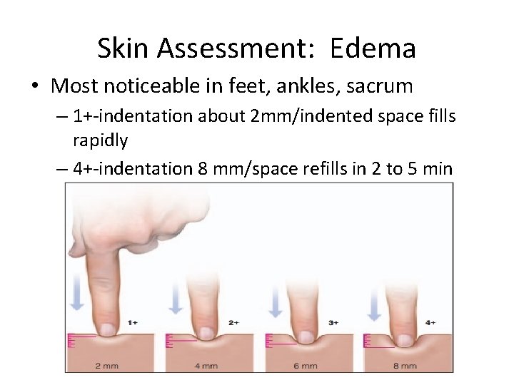 Skin Assessment: Edema • Most noticeable in feet, ankles, sacrum – 1+-indentation about 2