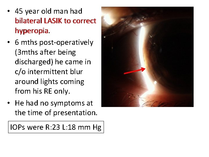  • 45 year old man had bilateral LASIK to correct hyperopia • 6