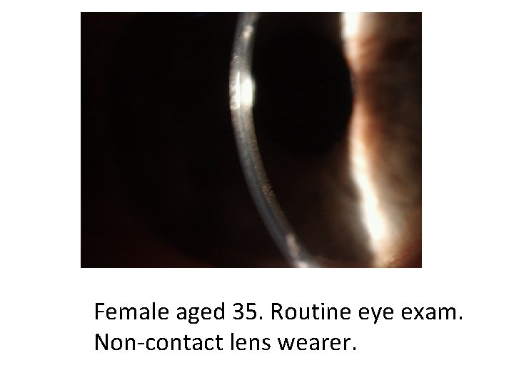 Female aged 35. Routine eye exam. Non-contact lens wearer. 