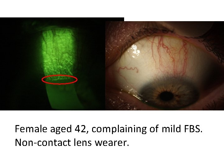 Female aged 42, complaining of mild FBS. Non-contact lens wearer. 