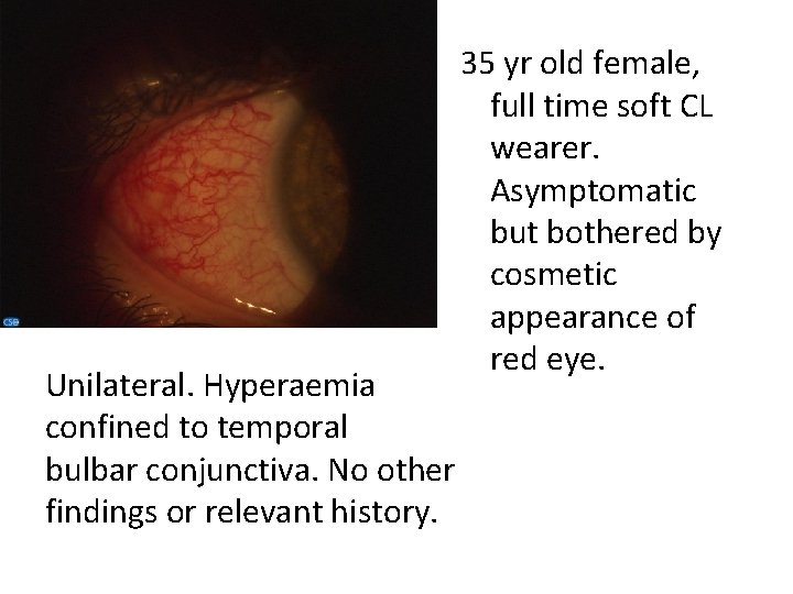 Unilateral. Hyperaemia confined to temporal bulbar conjunctiva. No other findings or relevant history. 35