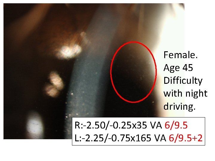 Female. Age 45 Difficulty with night driving. R: -2. 50/-0. 25 x 35 VA