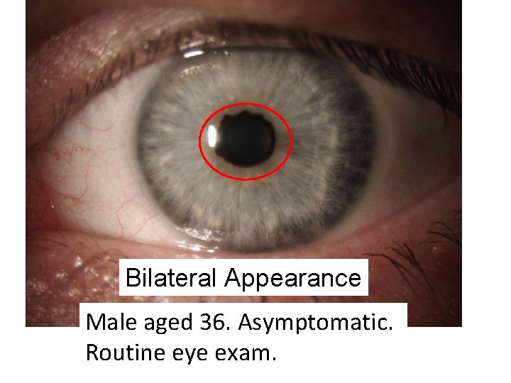 Bilateral Appearance Male aged 36. Asymptomatic. Routine eye exam. 