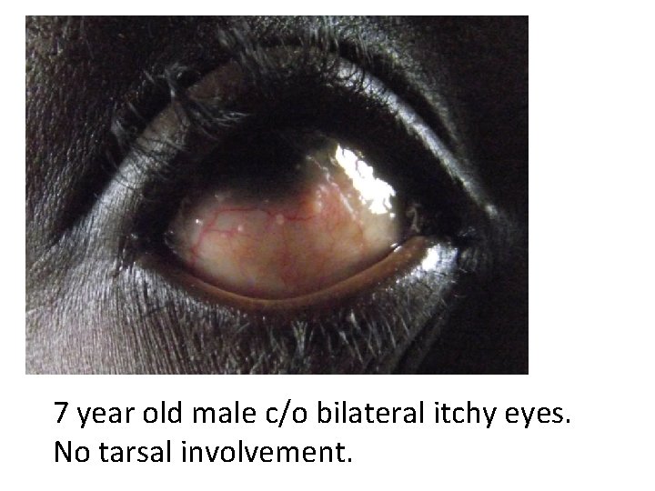 7 year old male c/o bilateral itchy eyes. No tarsal involvement. 