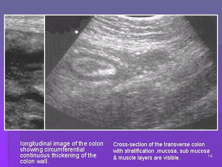  longitudinal image of the colon showing circumferential continuous thickening of the colon wall.