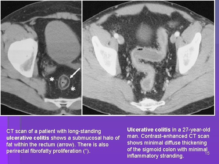 CT scan of a patient with long-standing ulcerative colitis shows a submucosal halo of