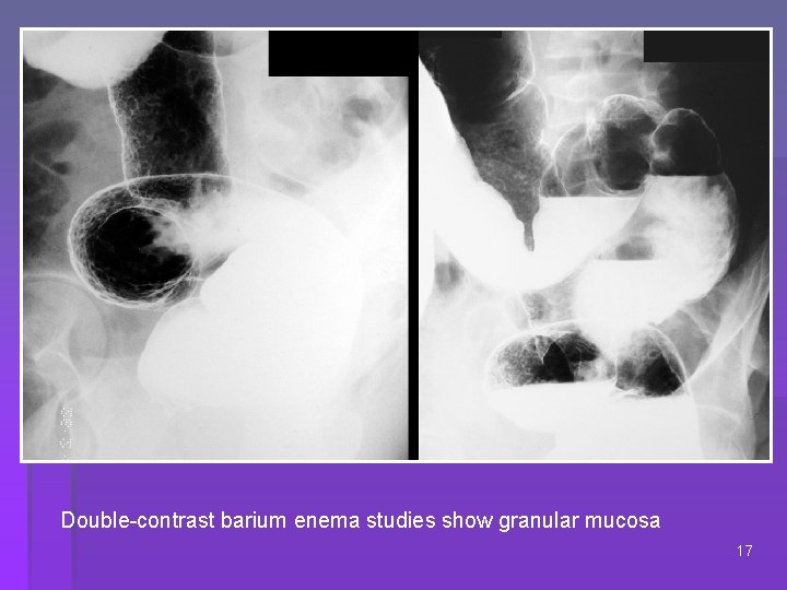 Double-contrast barium enema studies show granular mucosa 17 