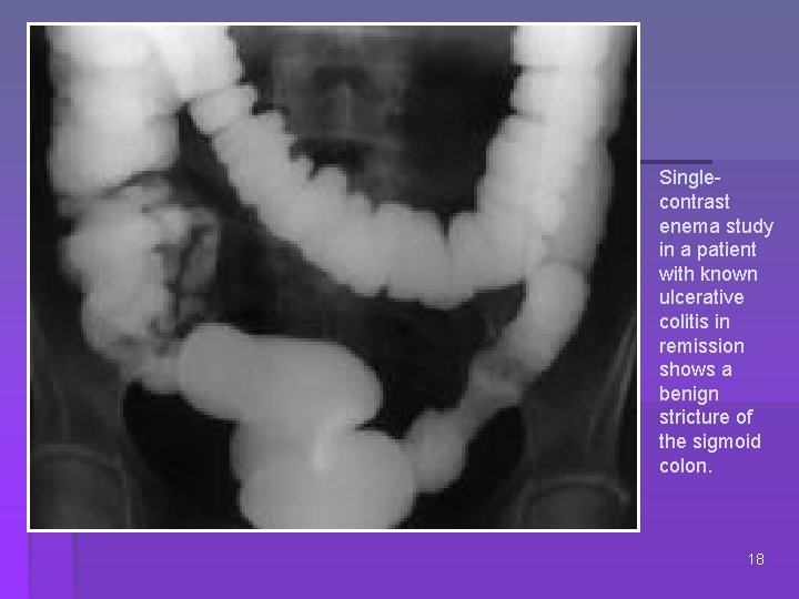 Singlecontrast enema study in a patient with known ulcerative colitis in remission shows a
