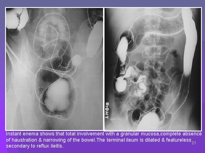 Instant enema shows that total involvement with a granular mucosa, complete absence of haustration