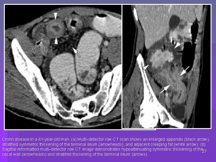 Crohn disease in a 41 -year-old man. (a) Multi–detector row CT scan shows an