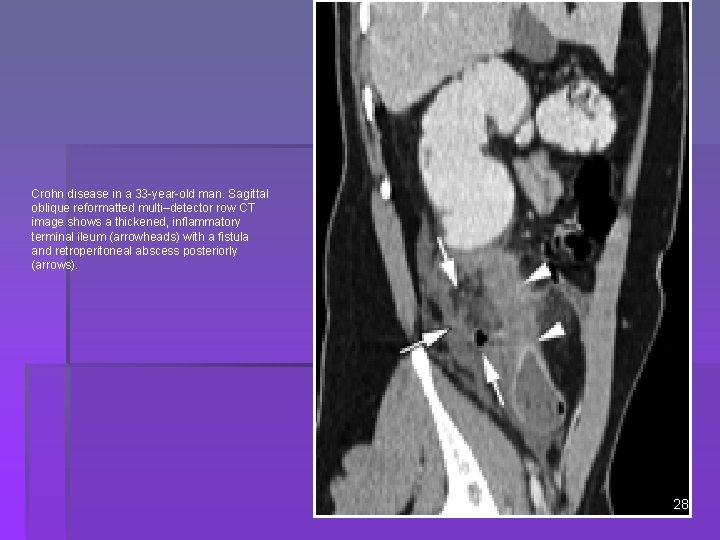 Crohn disease in a 33 -year-old man. Sagittal oblique reformatted multi–detector row CT image