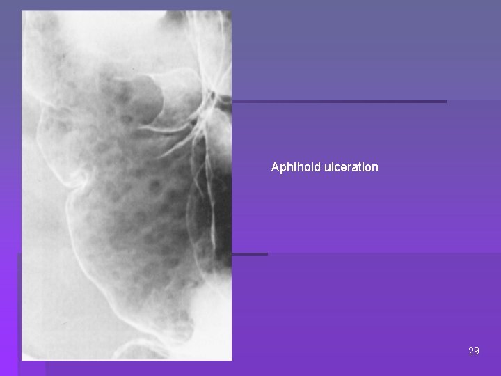Aphthoid ulceration 29 