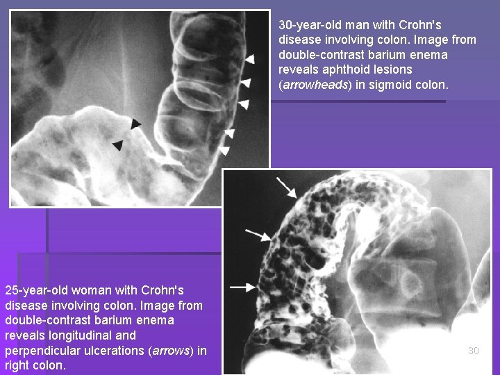 30 -year-old man with Crohn's disease involving colon. Image from double-contrast barium enema reveals