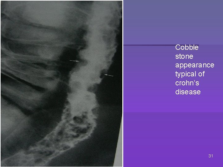 Cobble stone appearance typical of crohn’s disease 31 