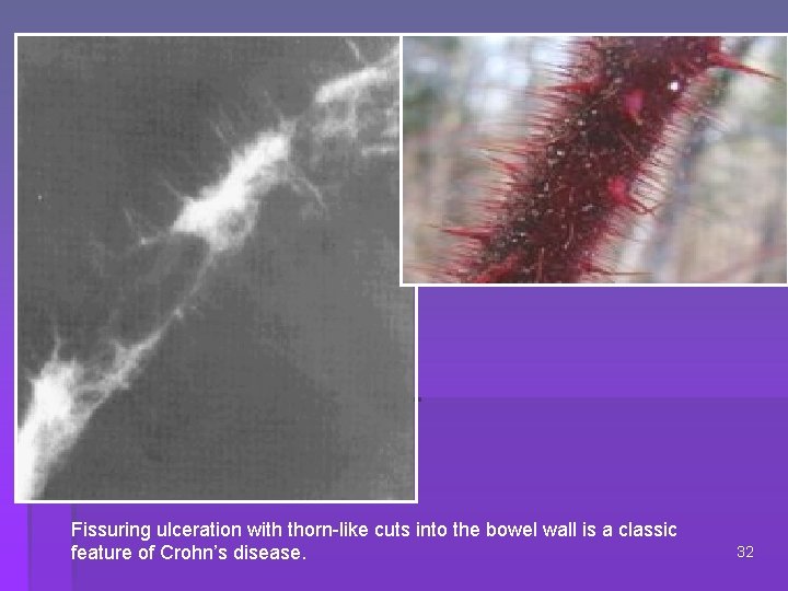 Fissuring ulceration with thorn-like cuts into the bowel wall is a classic feature of