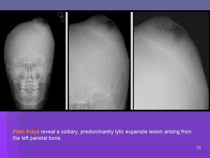 Plain Xrays reveal a solitary, predominantly lytic expansile lesion arising from the left parietal