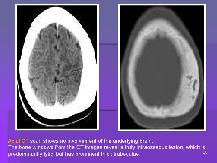 Axial CT scan shows no involvement of the underlying brain. The bone windows from