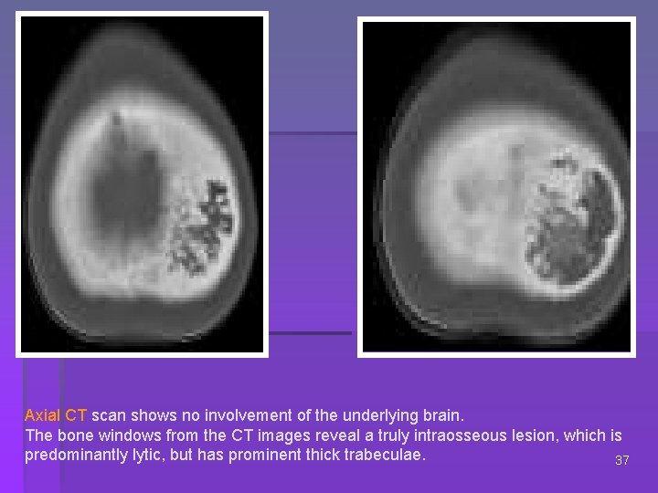 Axial CT scan shows no involvement of the underlying brain. The bone windows from