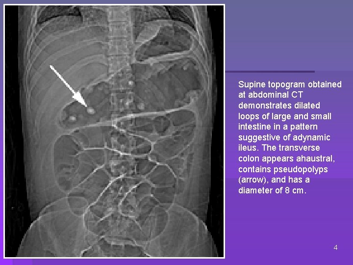 Supine topogram obtained at abdominal CT demonstrates dilated loops of large and small intestine