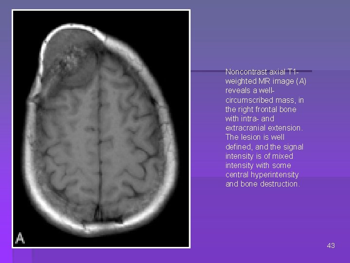 Noncontrast axial T 1 weighted MR image (A) reveals a wellcircumscribed mass, in the
