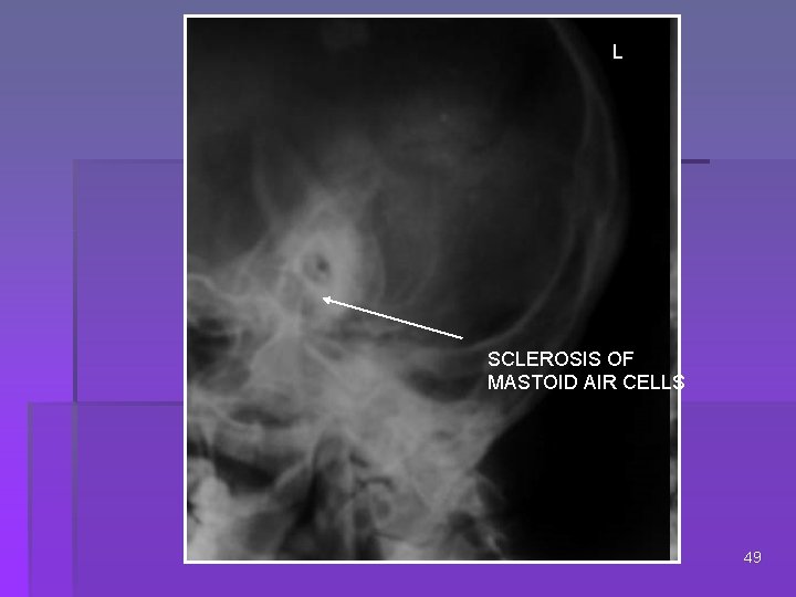 L SCLEROSIS OF MASTOID AIR CELLS 49 