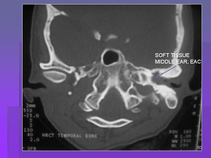 SOFT TISSUE MIDDLE EAR, EAC 50 