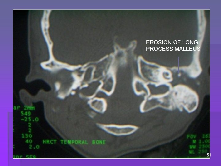 EROSION OF LONG PROCESS MALLEUS 51 