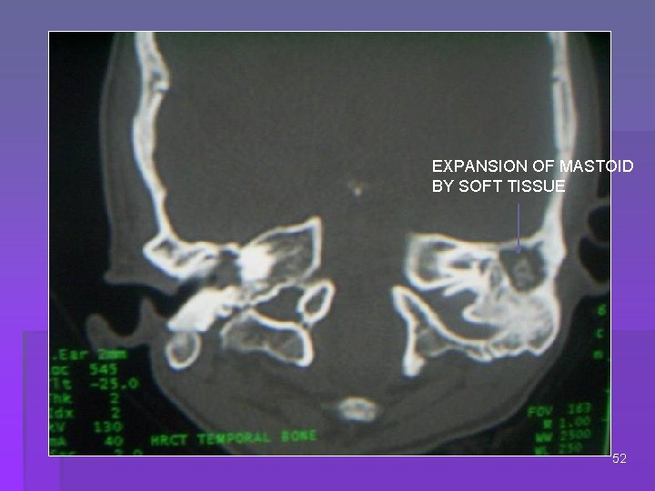 EXPANSION OF MASTOID BY SOFT TISSUE 52 