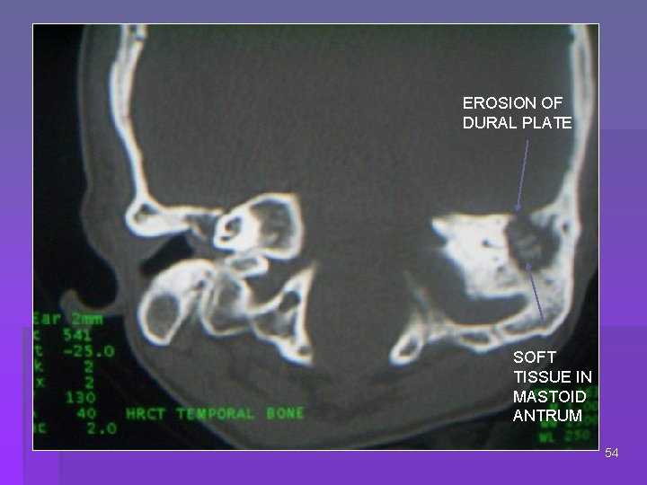 EROSION OF DURAL PLATE SOFT TISSUE IN MASTOID ANTRUM 54 