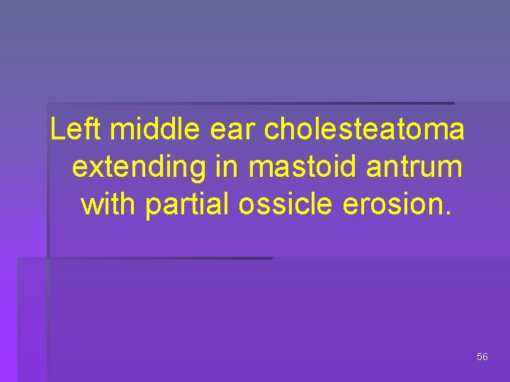 Left middle ear cholesteatoma extending in mastoid antrum with partial ossicle erosion. 56 