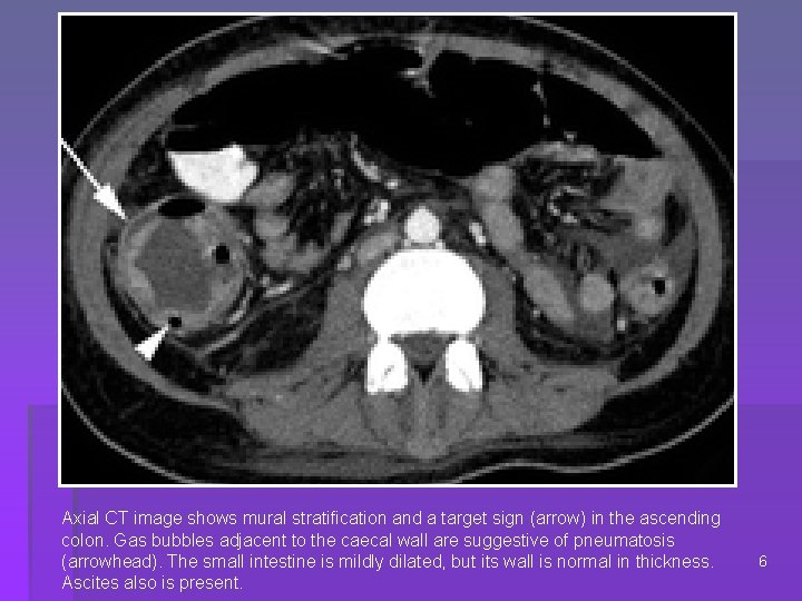 Axial CT image shows mural stratification and a target sign (arrow) in the ascending