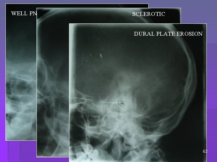 WELL PNEUMATIZED SCLEROTIC DURAL PLATE EROSION 62 