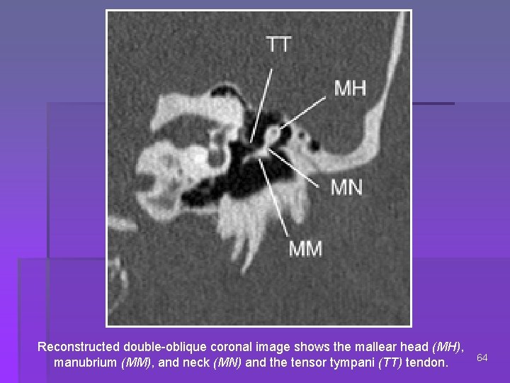 Reconstructed double-oblique coronal image shows the mallear head (MH), manubrium (MM), and neck (MN)