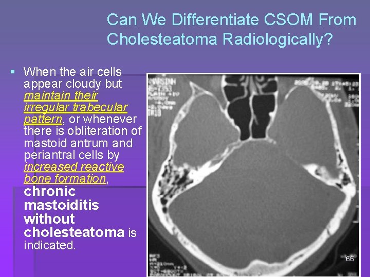 Can We Differentiate CSOM From Cholesteatoma Radiologically? § When the air cells appear cloudy