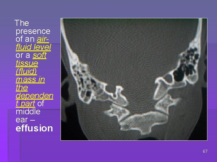  The presence of an airfluid level or a soft tissue (fluid) mass in
