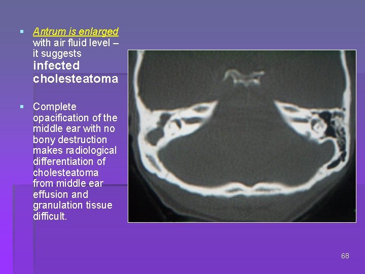 § Antrum is enlarged with air fluid level – it suggests infected cholesteatoma §