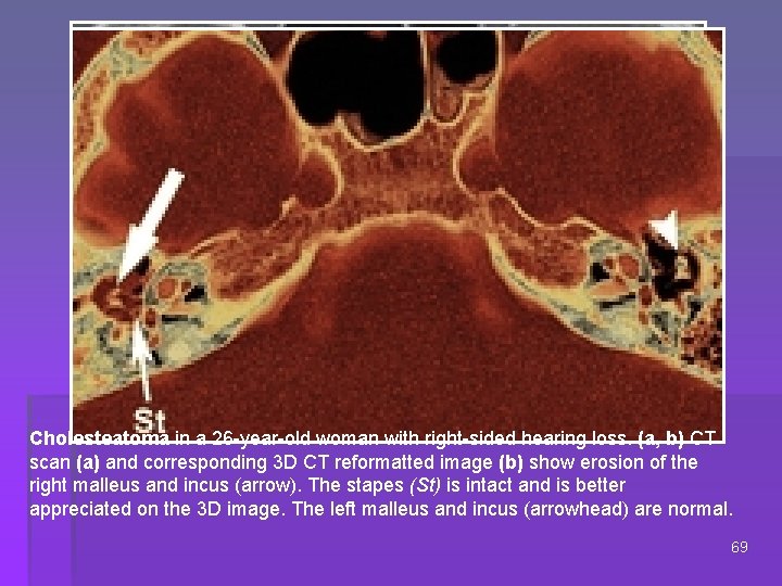 Cholesteatoma in a 26 -year-old woman with right-sided hearing loss. (a, b) CT scan