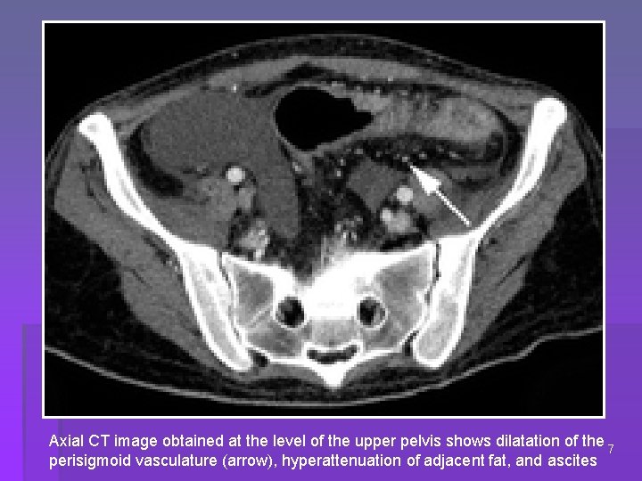 Axial CT image obtained at the level of the upper pelvis shows dilatation of