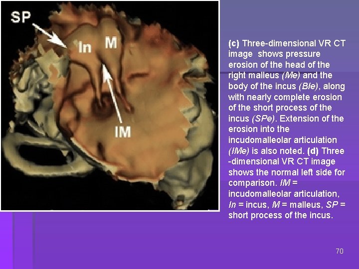 (c) Three-dimensional VR CT image shows pressure erosion of the head of the right