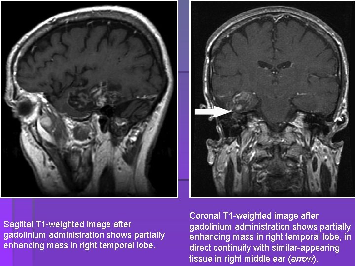 Sagittal T 1 -weighted image after gadolinium administration shows partially enhancing mass in right