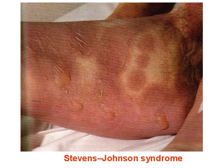 Stevens–Johnson syndrome 