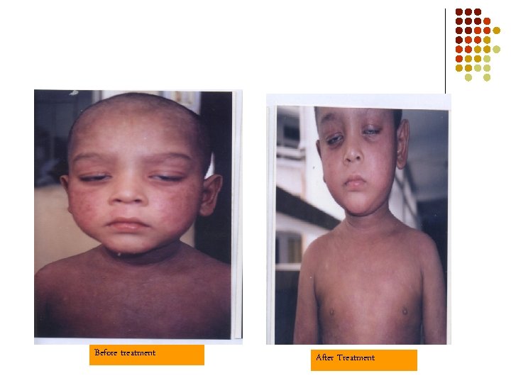 Before treatment After Treatment 