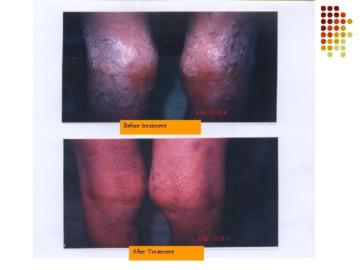 Before treatment After Treatment 